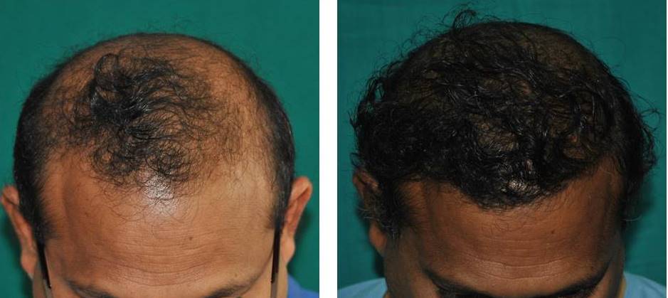 Hair transplant for front zone